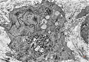 M,40y. | granular cell tumor